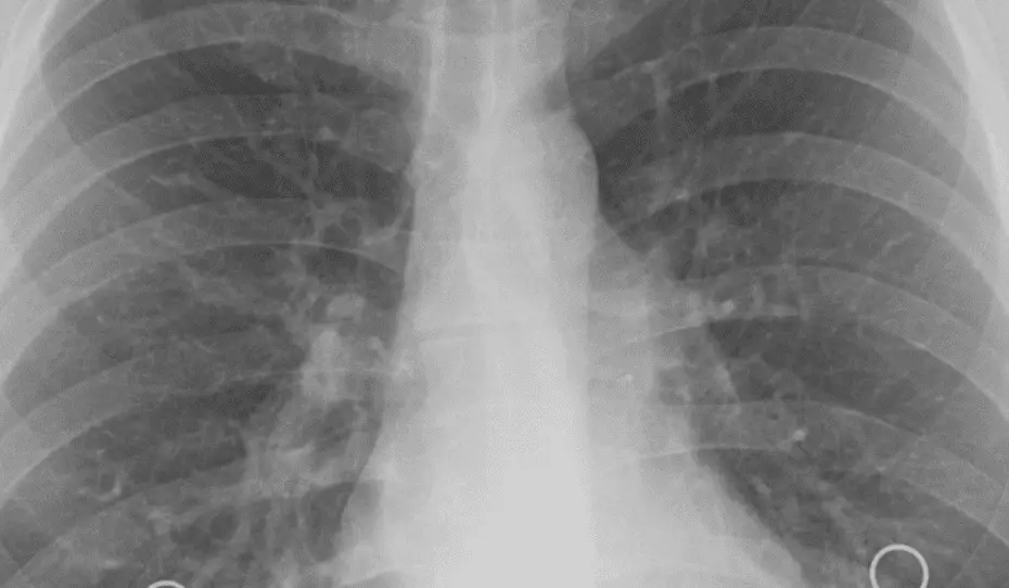 Warum sind Röntgenstrahlen gefährlich